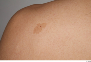 Jorge birthmarks skin 0001.jpg